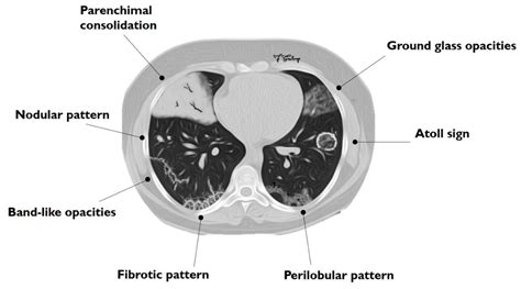 Cryptogenic organizing pneumonia